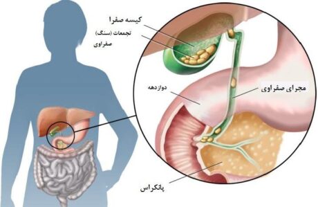 پک صفرا