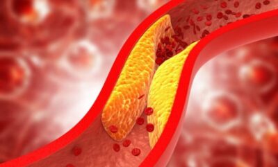 همه چیز درباره انسداد عروق