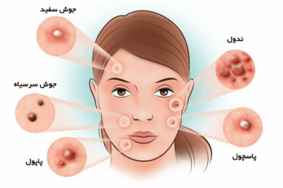 همه چیز درباره آکنه؛ از علل تا درمان‌های طبیعی