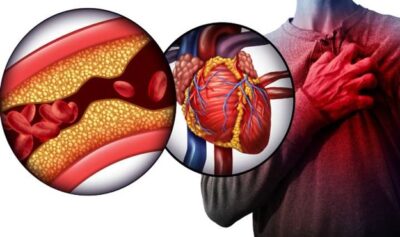 همه چیز درباره انسداد عروق