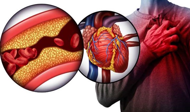 همه چیز درباره انسداد عروق