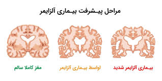 آلزایمر: علل، علائم