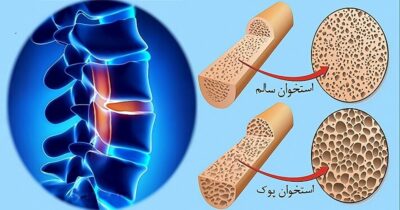 پوکی استخوان؛ بیماری خاموش استخوان‌ها