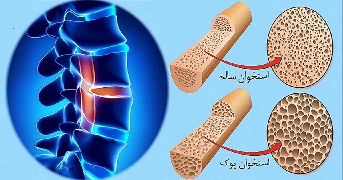 پوکی استخوان؛ بیماری خاموش استخوان‌ها
