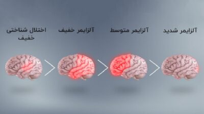 آلزایمر: علل، علائم
