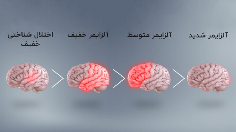 آلزایمر: علل، علائم