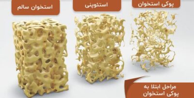 پوکی استخوان؛ بیماری خاموش استخوان‌ها